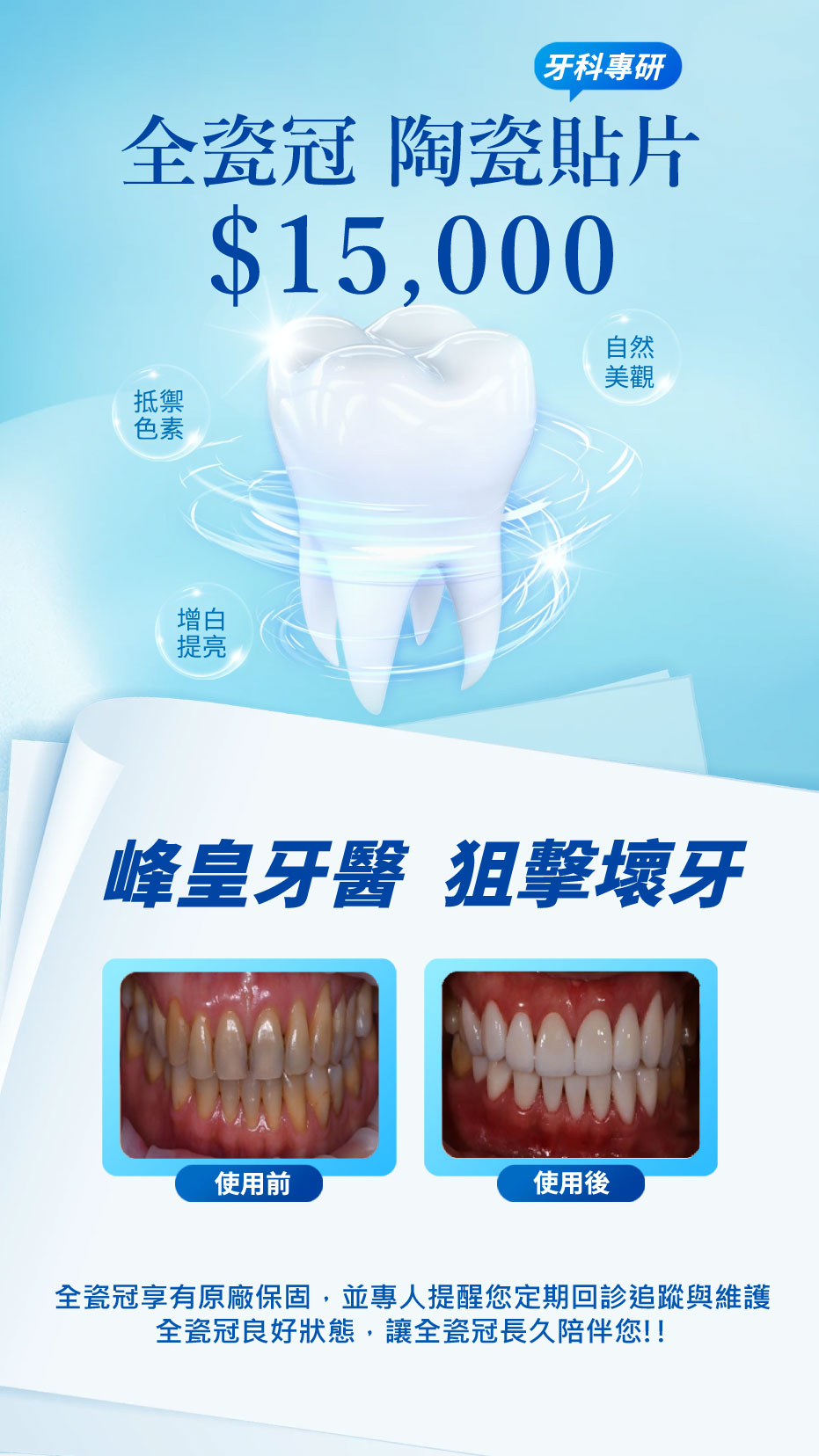 全瓷冠 陶瓷貼片15000